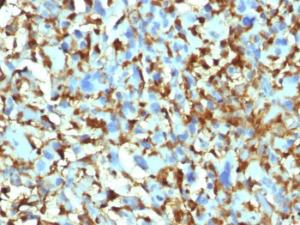 Immunohistochemical analysis of formalin-fixed, paraffin-embedded human histiocytoma using Anti-Factor XIIIa Antibody [F13A1/1448]