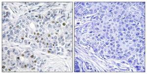 Immunohistochemical analysis of paraffin-embedded human breast carcinoma tissue using Anti-Retinoblastoma Antibody. The right hand panel represents a negative control, where the antibody was pre-incubated with the immunising peptide.