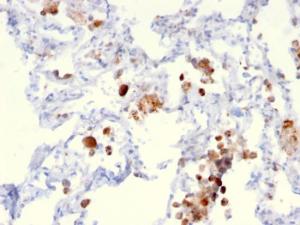 Immunohistochemical analysis of formalin-fixed, paraffin-embedded human lung adenocarcinoma using Anti-NAPSIN A Antibody [NAPSA/3306]