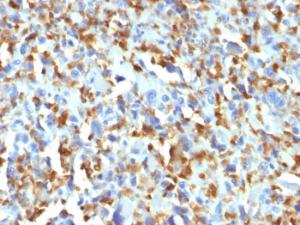 Immunohistochemical analysis of formalin-fixed, paraffin-embedded human histiocytoma using Anti-Factor XIIIa Antibody [F13A1/1683]