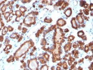 Immunohistochemical analysis of formalin-fixed, paraffin-embedded human thyroid carcinoma using Anti-Thyroid Peroxidase Antibody [TPO/3698]