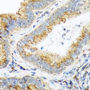 Immunohistochemistry analysis of paraffin-embedded human colon carcinoma tissue using Anti-alpha COP I/COPA Antibody [ARC2215] (A307527) at a dilution of 1:100(40X lens). Perform microwave antigen retrieval with 10 mM Tris/EDTA buffer pH 9.0 before commencing with IHC staining protocol