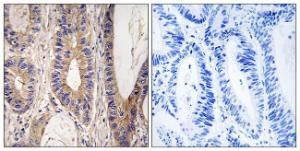 Immunohistochemical analysis of paraffin-embedded human colon carcinoma tissue using Anti-UPF1 Antibody. The right hand panel represents a negative control, where the antibody was pre-incubated with the immunising peptide