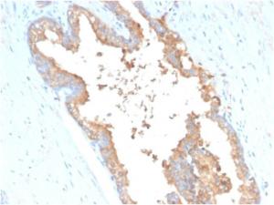 Immunohistochemical analysis of formalin-fixed, paraffin-embedded human prostate carcinoma using Anti-Transferrin Antibody [TF/3001]