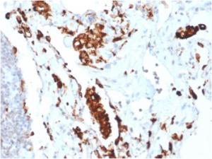 Immunohistochemical analysis of formalin-fixed, paraffin-embedded human lung adenocarcinoma using Anti-NAPSIN A Antibody [NAPSA/1865R]