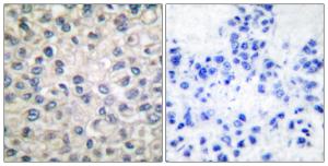 Immunohistochemical analysis of paraffin-embedded human breast carcinoma tissue using Anti-Catenin-alpha1 Antibody. The right hand panel represents a negative control, where the antibody was pre-incubated with the immunising peptide