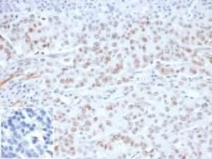 Immunohistochemical analysis of formalin-fixed, paraffin-embedded Lynch syndrome/hereditary non-polyposis colorectal cancer (HNPCC) using Anti-MLH1 Antibody [MLH1/6284R] at 2 µg/ml in PBS for 30 minutes at room temperature Inset