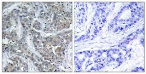 Immunohistochemical analysis of paraffin-embedded human breast carcinoma tissue using Anti-Stathmin 1 Antibody. The right hand panel represents a negative control, where the antibody was pre-incubated with the immunising peptide