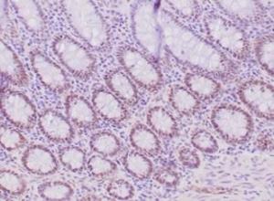 Immunohistochemical analysis of formalin-fixed, paraffin-embedded human colon carcinoma tissue using Anti-MLH1 Antibody [MLH1/6284R]