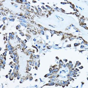 Immunohistochemistry analysis of paraffin-embedded human thyroid cancer using Anti-ATP5O Antibody (A10296) at a dilution of 1:100 (40X lens). Perform high pressure antigen retrieval with 10 mM citrate buffer pH 6.0 before commencing with IHC staining protocol