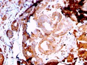 Immunohistochemical analysis of formalin-fixed, paraffin-embedded human breast carcinoma using Anti-GRP94 Antibody [HSP90B1/3168R]