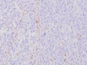 Immunohistochemical analysis of formalin-fixed, paraffin-embedded human hereditary nonpolyposis colorectal cancer (HNPCC)/Lynch syndrome using Anti-MLH1 Antibody [MLH1/6284R] at 2 µg/ml