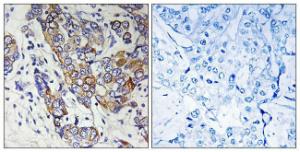 Immunohistochemical analysis of paraffin-embedded human breast carcinoma tissue using Anti-CBR1 Antibody. The right hand panel represents a negative control, where the antibody was pre-incubated with the immunising peptide