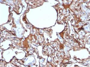 Immunohistochemical analysis of formalin-fixed, paraffin-embedded human melanoma using Anti-CD146 Antibody [SPM620]