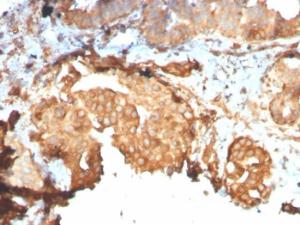 Immunohistochemical analysis of formalin-fixed, paraffin-embedded human breast carcinoma using Anti-GRP94 Antibody [HSP90B1/3168R]