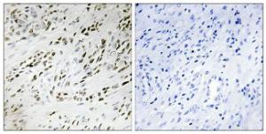 Immunohistochemical analysis of paraffin-embedded human prostate carcinoma tissue using Anti-TSH2 Antibody. The right hand panel represents a negative control, where the Antibody was pre-incubated with the immunising peptide