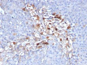 Immunohistochemical analysis of formalin-fixed, paraffin-embedded human melanoma using Anti-CD146 Antibody [C146/634]