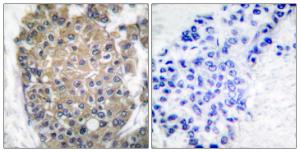 Immunohistochemical analysis of paraffin-embedded human breast carcinoma tissue using Anti-Keratin 17 Antibody. The right hand panel represents a negative control, where the antibody was pre-incubated with the immunising peptide.