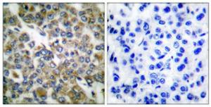 Immunohistochemical analysis of paraffin-embedded human breast carcinoma tissue using Anti-Keratin 14 Antibody The right hand panel represents a negative control, where the antibody was pre-incubated with the immunising peptide