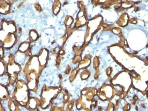 Immunohistochemical analysis of formalin-fixed, paraffin-embedded human angiosarcoma using Anti-CD34 Antibody [HPCA1/763]