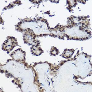 Immunohistochemistry analysis of paraffin-embedded human thyroid cancer using Anti-Cystatin-B Antibody (A307532) at a dilution of 1:100 (40x lens). Perform high pressure antigen retrieval with 10 mM citrate buffer pH 6.0 before commencing with IHC staining protocol.