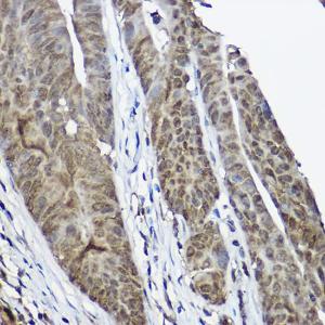 Immunohistochemistry analysis of paraffin-embedded human colon carcinoma tissue using Anti-Cystatin-B Antibody (A307532) at a dilution of 1:100 (40x lens). Perform high pressure antigen retrieval with 10 mM citrate buffer pH 6.0 before commencing with IHC staining protocol.