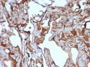 Immunohistochemical analysis of formalin-fixed, paraffin-embedded human melanoma using Anti-CD146 Antibody [MUC18/1130]