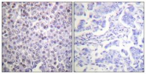 Immunohistochemical analysis of paraffin-embedded human breast carcinoma tissue using Anti-Histone H4 Antibody. The right hand panel represents a negative control, where the antibody was pre-incubated with the immunising peptide.