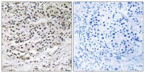 Immunohistochemical analysis of paraffin-embedded human breast carcinoma tissue using Anti-AZI1 Antibody. The right hand panel represents a negative control, where the antibody was pre-incubated with the immunising peptide