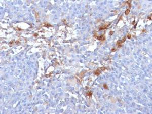 Immunohistochemical analysis of formalin-fixed, paraffin-embedded human melanoma using Anti-CD146 Antibody [MUC18/1130]