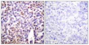 Immunohistochemical analysis of paraffin-embedded human breast carcinoma tissue using Anti-Histone H4 Antibody. The right hand panel represents a negative control, where the Antibody was pre-incubated with the immunising peptide