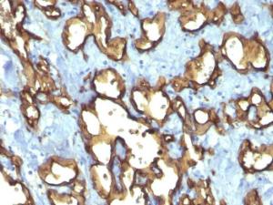 Immunohistochemical analysis of formalin-fixed, paraffin-embedded human angiosarcoma using Anti-CD34 Antibody [QBEnd/10 + HPCA1/763]