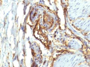 Immunohistochemical analysis of formalin-fixed, paraffin-embedded human colon carcinoma using Anti-CD34 Antibody [QBEnd/10 + HPCA1/763]