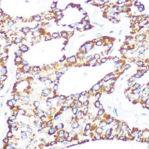 Immunohistochemistry analysis of paraffin-embedded human lung cancer using Anti-gamma Catenin Antibody [ARC0909] (A305834) at a dilution of 1:100 (40x lens) Perform microwave antigen retrieval with 10 mM PBS buffer pH 72 before commencing with IHC staining protocol