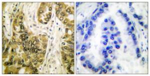 Immunohistochemical analysis of paraffin-embedded human lung carcinoma tissue using Anti-Galectin 3 Antibody. The right hand panel represents a negative control, where the Antibody was pre-incubated with the immunising peptide