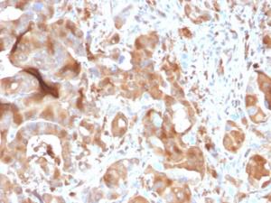 Immunohistochemical analysis of formalin-fixed, paraffin-embedded human hepatic carcinoma using Anti-FABP5 Antibody [CPTC-FABP5-3]