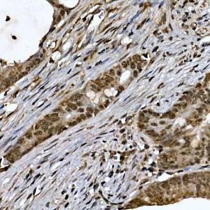 Immunohistochemistry analysis of paraffin-embedded human colon carcinoma tissue using Anti-ZNF213 Antibody (A308521) at a dilution of 1:100 (40x lens). Perform high pressure antigen retrieval with 10 mM citrate buffer pH 6.0 before commencing with IHC staining protocol.