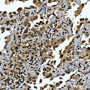 Immunohistochemistry analysis of paraffin-embedded human lung cancer using Anti-ZNF213 Antibody (A308521) at a dilution of 1:100 (40x lens). Perform high pressure antigen retrieval with 10 mM citrate buffer pH 6.0 before commencing with IHC staining protocol.