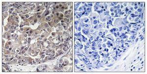 Immunohistochemical analysis of paraffin-embedded human breast cancer using Anti-IFIH1 Antibody 1:100 (4°C overnight). The right hand panel represents a negative control, where the antibody was pre-incubated with the immunising peptide