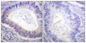 Immunohistochemical analysis of paraffin-embedded human colon carcinoma using Anti-PDE4D (phospho Ser190 + Ser53) Antibody. The right hand panel represents a negative control, where the antibody was pre-incubated with the immunising peptide