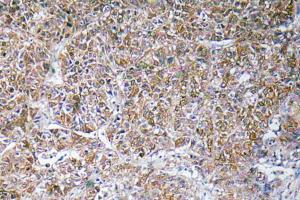 Immunohistochemical analysis of paraffin-embedded human liver carcinoma tissue using Anti-ACBP Antibody