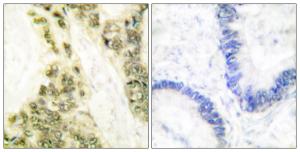 Immunohistochemical analysis of paraffin-embedded human colon carcinoma tissue using Anti-Thyroid Hormone Receptor alpha Antibody. The right hand panel represents a negative control, where the antibody was pre-incubated with the immunising peptide