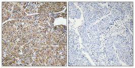 Immunohistochemical analysis of paraffin-embedded human lung cancer using Anti-ACBP Antibody 1:100 (4°C overnight). The right hand panel represents a negative control, where the antibody was pre-incubated with the immunising peptide