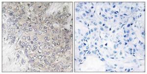 Immunohistochemical analysis of paraffin-embedded human breast carcinoma using Anti-p70 S6 Kinase (phospho Thr421) Antibody. The right hand panel represents a negative control, where the antibody was pre-incubated with the immunising peptide