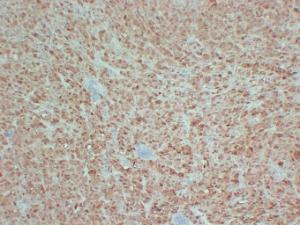 Immunohistochemical analysis of paraffin-embedded human Malignant melanoma using Anti-S100 Antibody