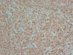 Immunohistochemical analysis of paraffin-embedded human Malignant melanoma using Anti-S100 Antibody