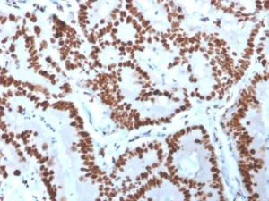 Immunohistochemical analysis of formalin-fixed, paraffin-embedded human colon carcinoma using Anti-MCM6 Antibody [MCM6/3000]