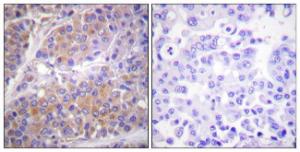 Immunohistochemical analysis of paraffin-embedded human breast carcinoma using Anti-p70 S6 Kinase (phospho Ser371) Antibody. The right hand panel represents a negative control, where the antibody was pre-incubated with the immunising peptide.