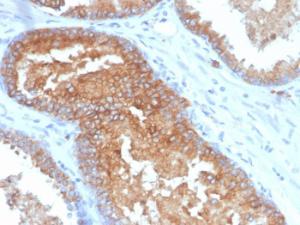 Immunohistochemical analysis of formalin-fixed, paraffin-embedded human prostate carcinoma using Anti-CD38 Antibody [CD38/4328]