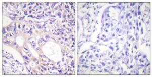 Immunohistochemical analysis of paraffin-embedded human breast carcinoma using Anti-Aurora Kinase (phospho Thr288) Antibody. The right hand panel represents a negative control, where the antibody was pre-incubated with the immunising peptide.